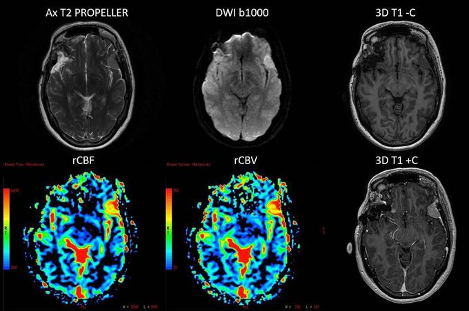 MR Imaging of brain's meningioma