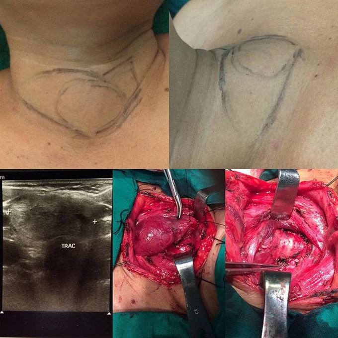 Thyroidectomy (laryngeus nerve preserving)... 