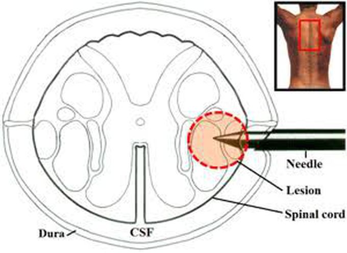 Cordotomy