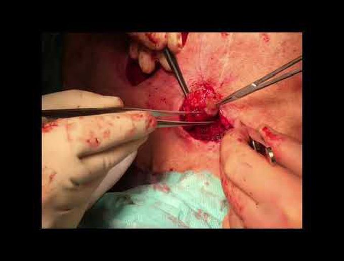 Closure of Tracheocutaneous Fistula After Prolonged Tracheostomy