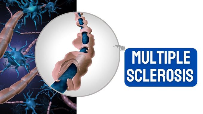 Multiple Sclerosis (MS): Pathophysiology, symptoms, Diagnosis & treatment