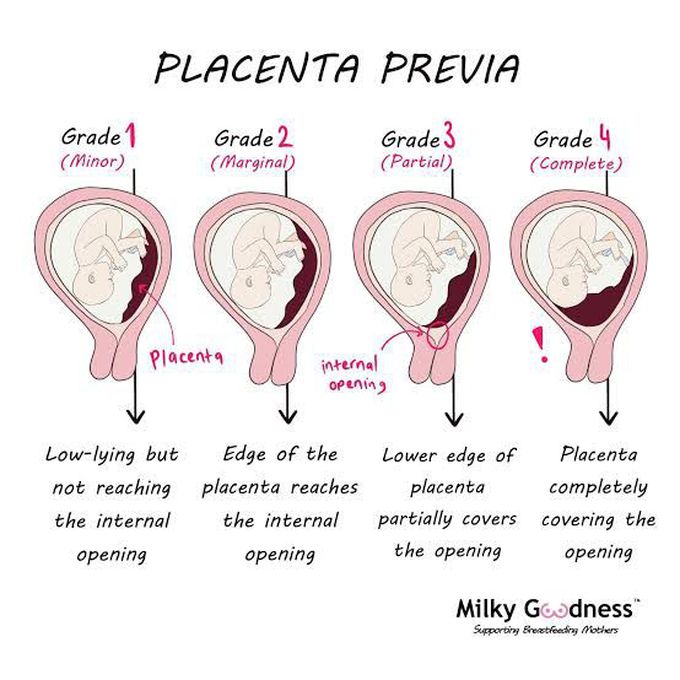 Placenta Previa Grading