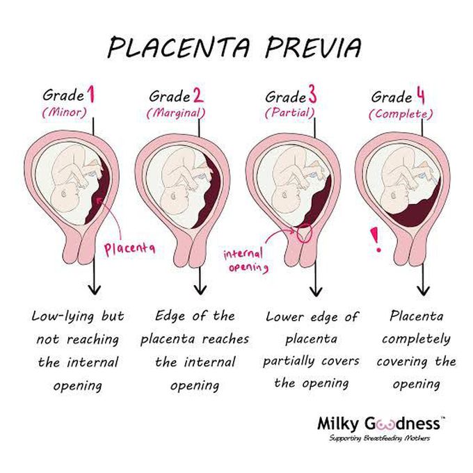 placenta-previa-grading-medizzy