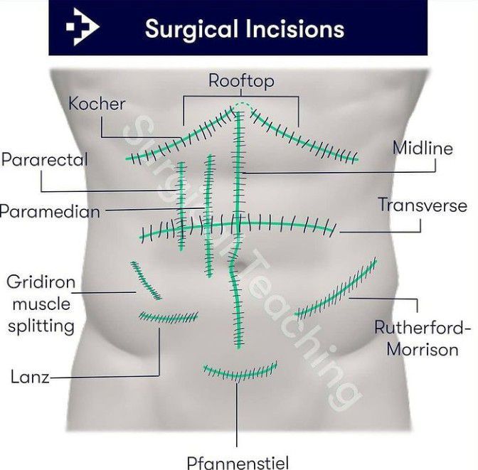 Types Of Surgical Incision Medizzy