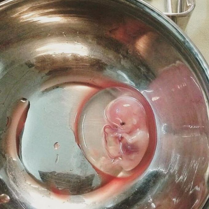 An aborted 9 weeks fetus