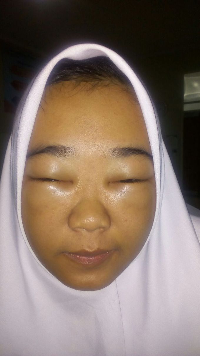 What an Allergy??