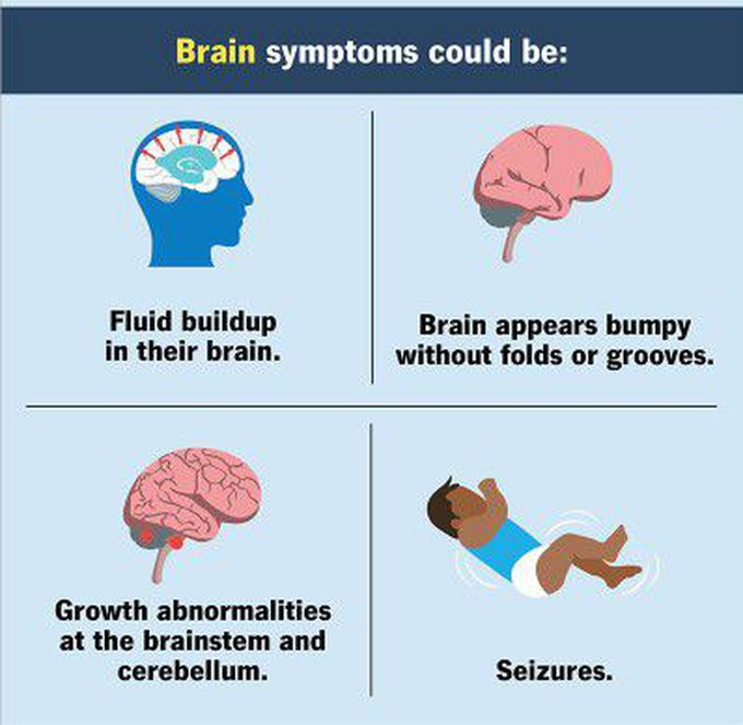 These are the brain symptoms of  Walker warburg syndrome