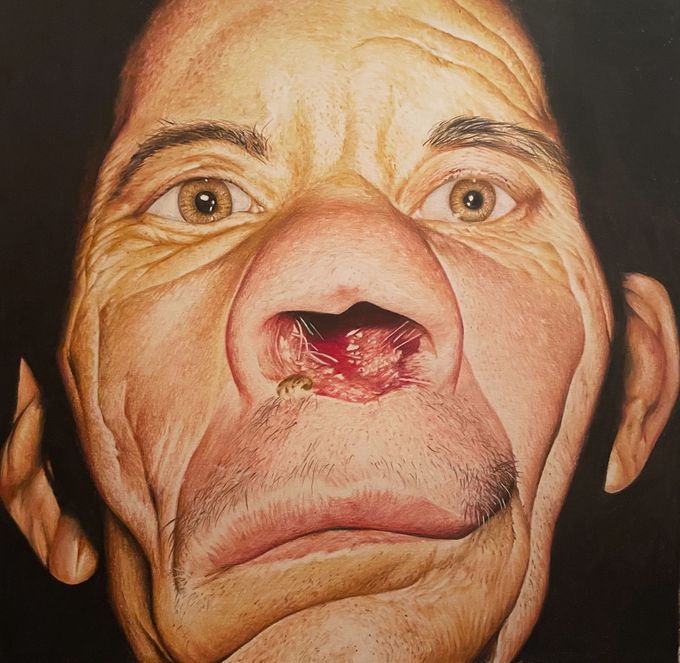 Coloured pencil portrait of a man with mucocutaneous leishmaniasis