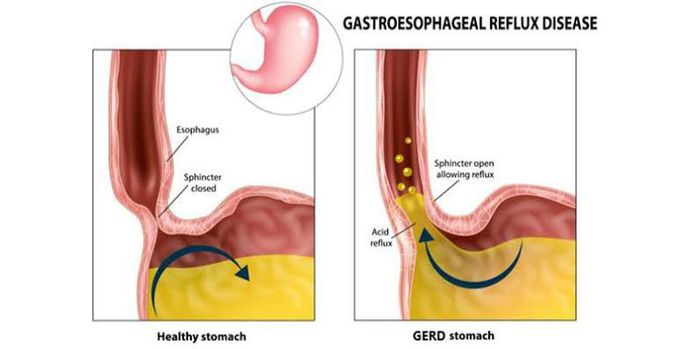 Gastro-esophageal Reflux Disease