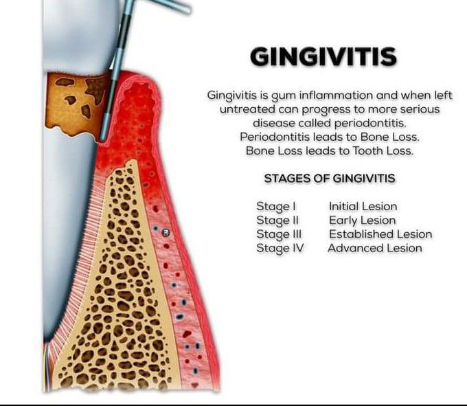 Gingivitis and its stages