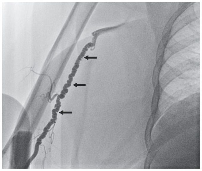 Fibromuscular Dysplasia of the Brachial Artery