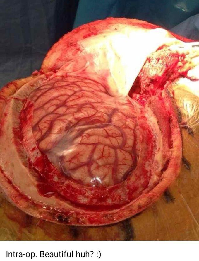 Neurosurgery