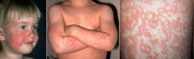 Erythema infectiosum causes