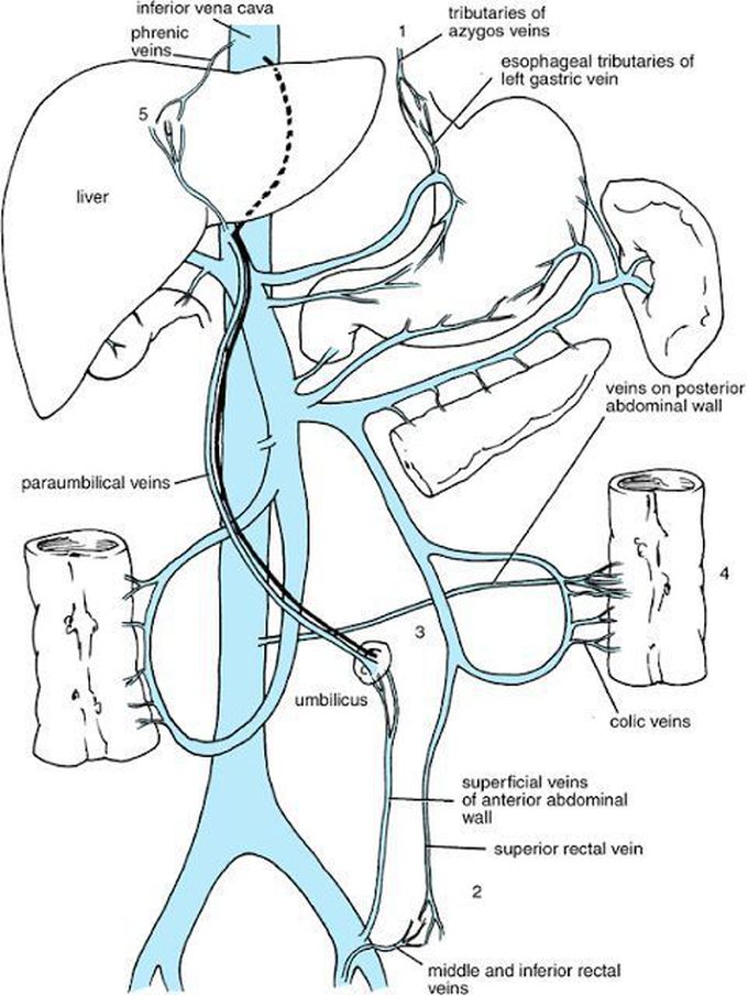 portacaval anastomosis