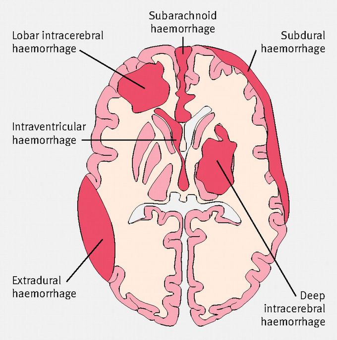 Hemorrhage