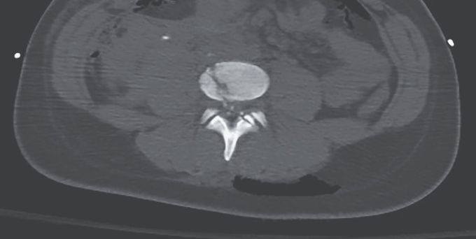 Comminuted Lumbar Vertebral Fracture