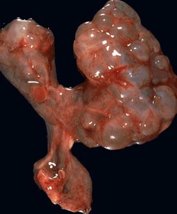 Multicystic renal dysplasia