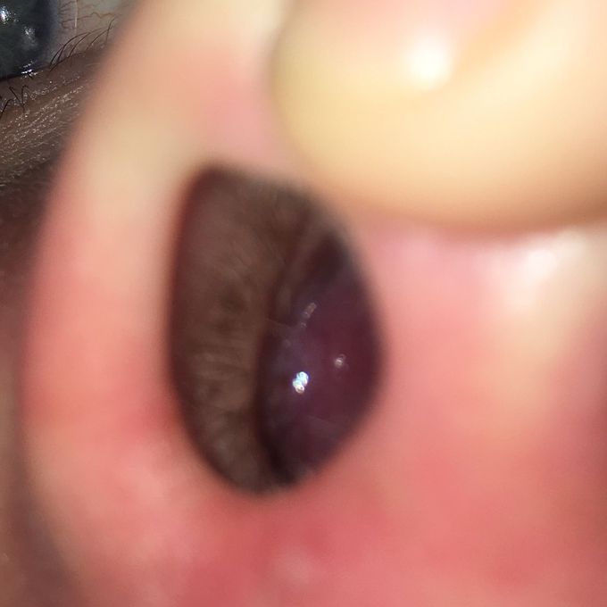 Patient presents with trouble breathing out of both nostrils. Diagnosis ?