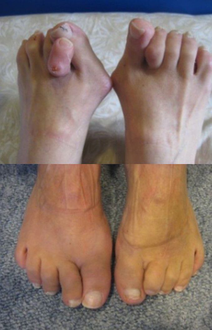 how-does-bunion-surgery-work-medizzy