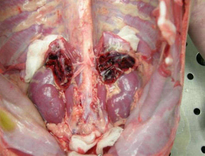 Waterhouse Friderichsen syndrome