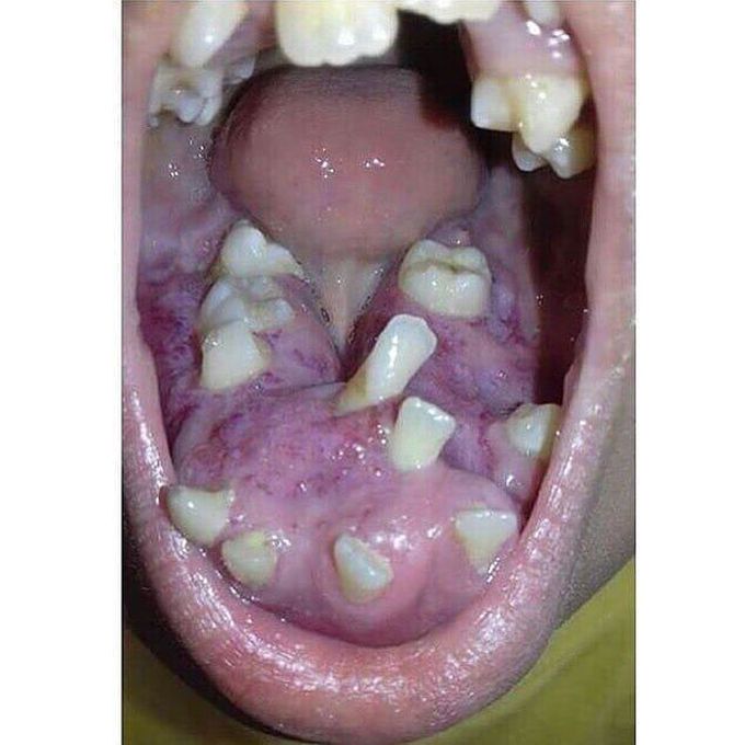 Very rare Gum disease