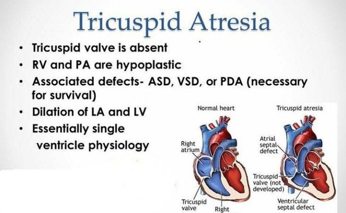 Tricuspid atresia