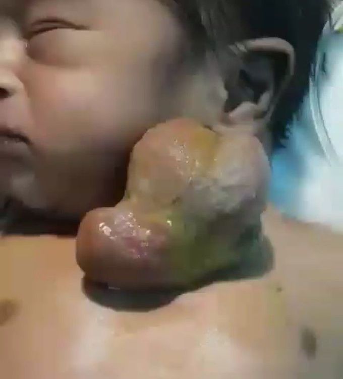 Ectopic cordis