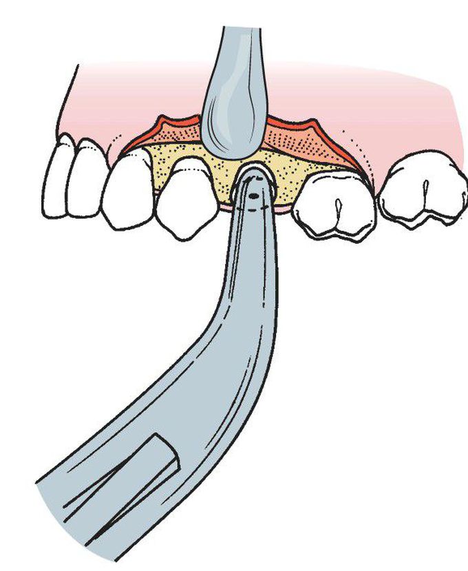 Extraction of fractured root