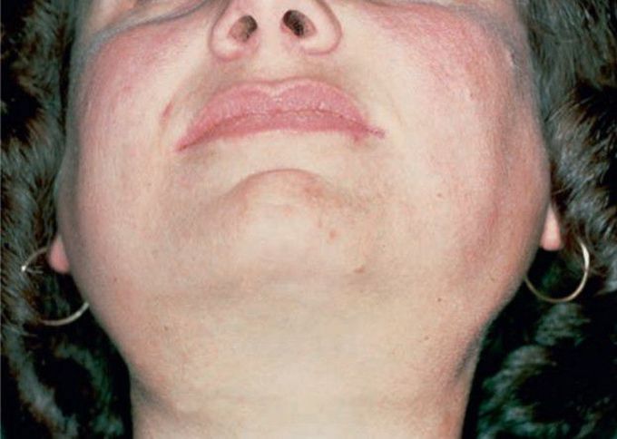 Bilateral parotid swelling in sjogren's syndrome