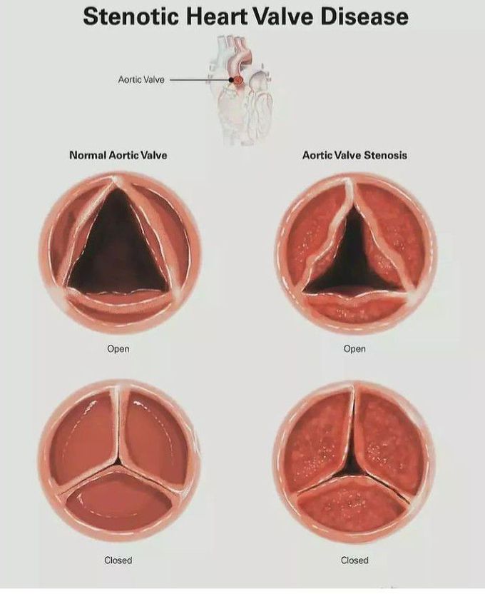 Aortic Stenosis