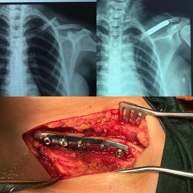 Clavicle again