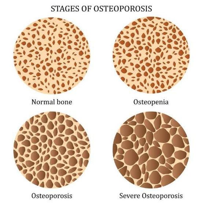 Stages of Osteoporosis