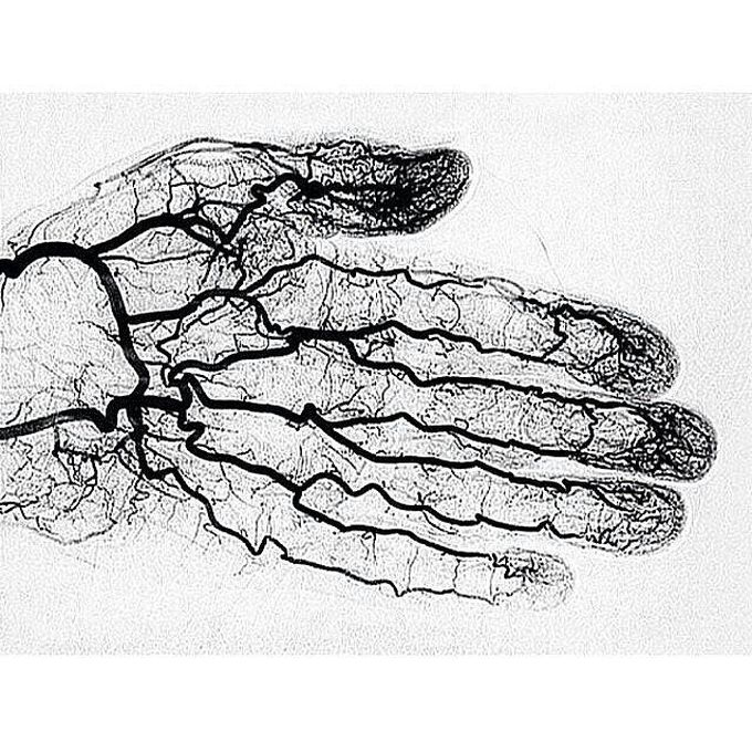 Angiography Of Hand Vessels Medical Medicine Medizzy