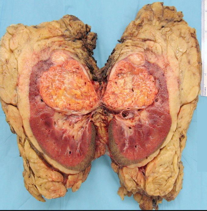 Renal cell carcinoma