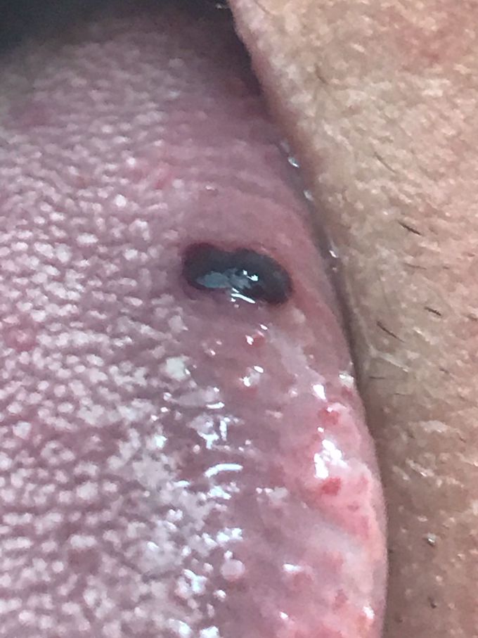 Black bump on tongue