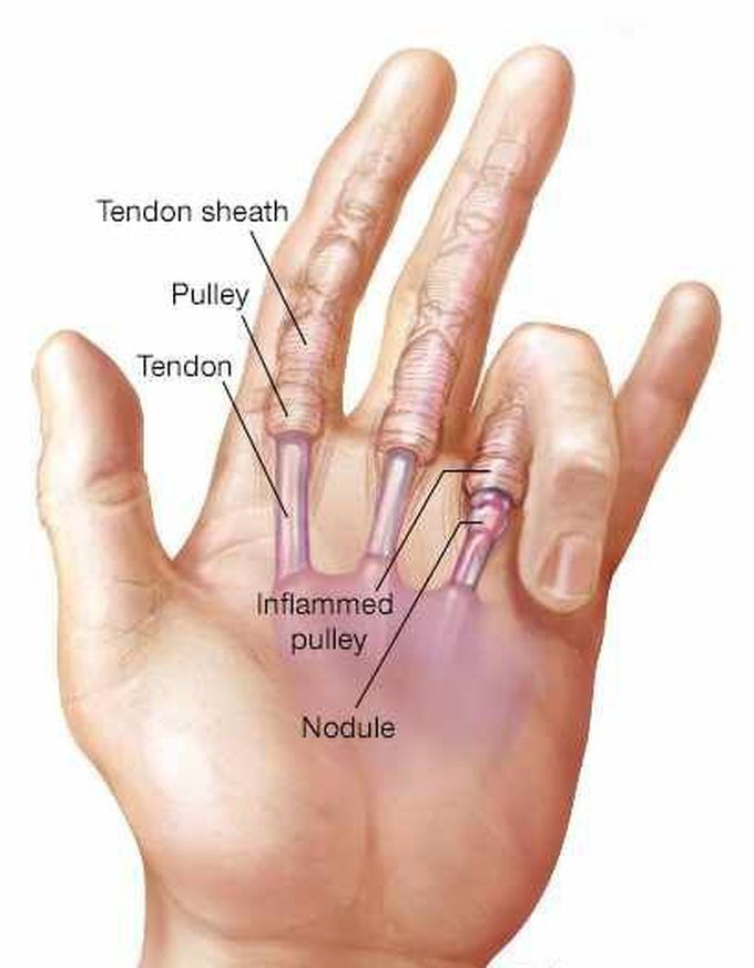 trigger finger