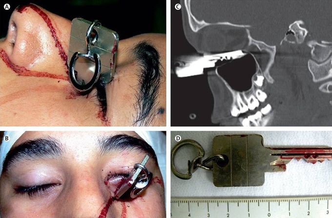 A 15-year-old boy presented to emergency department with a key penetrating his left orbit