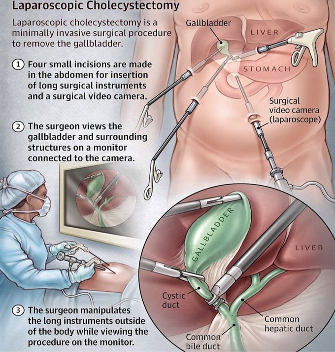 Laparoscopic Cholecystectomy