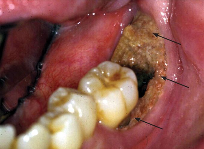 Bisphosphonate-related Osteonecrosis of the jaw in a patient with Osteoporosis
