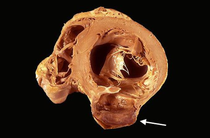 Ventricular Aneurysm post-MI