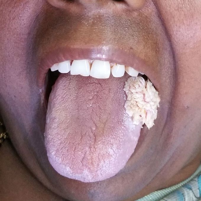 Verrucous Carcinoma