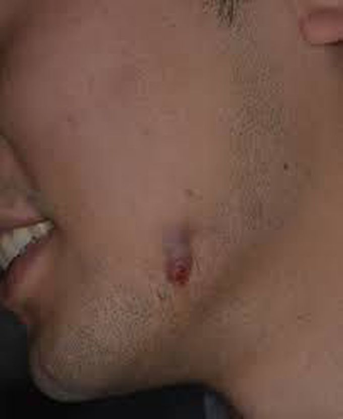 Nodule