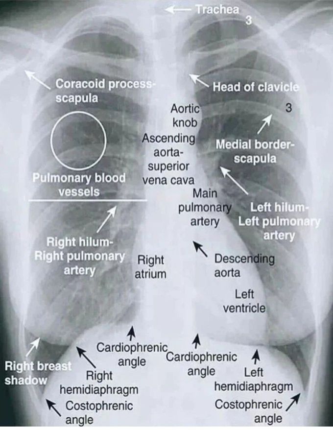 CXR Interpretation