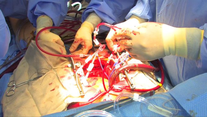 Coronary Artery Bypass