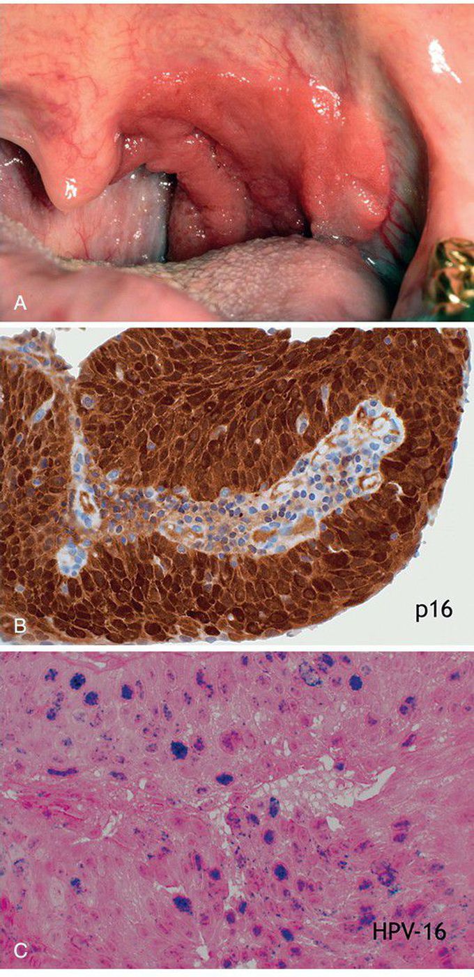 Squamous Cell Carcinoma, Oropharyngeal