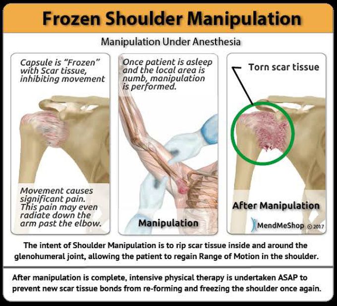 Adhesive Capsulitis- Manipulation