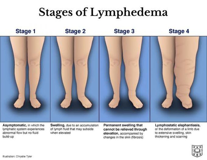 Stages of lymphedema