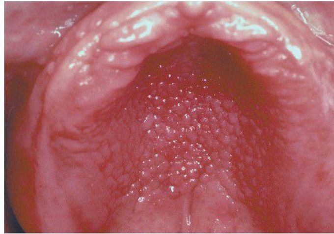 Inflammatory Papillary Hyperplasia.