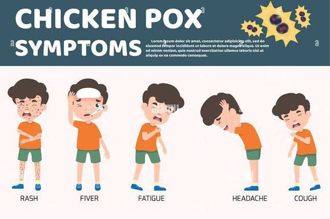 Symptoms of chicken pox