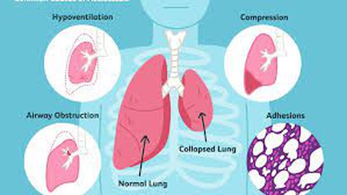 Causes of Atelectasis